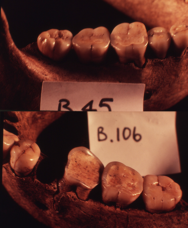 Broadbeach mandibular teeth